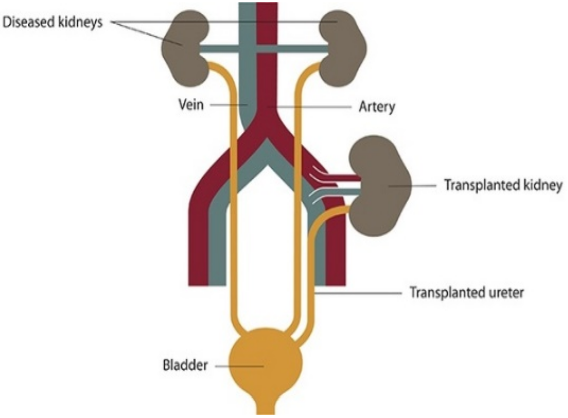 Schema of kidney transplantation.